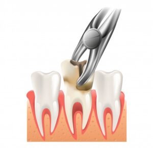 wisdom tooth extraction