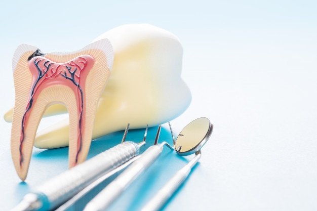root canal treatment