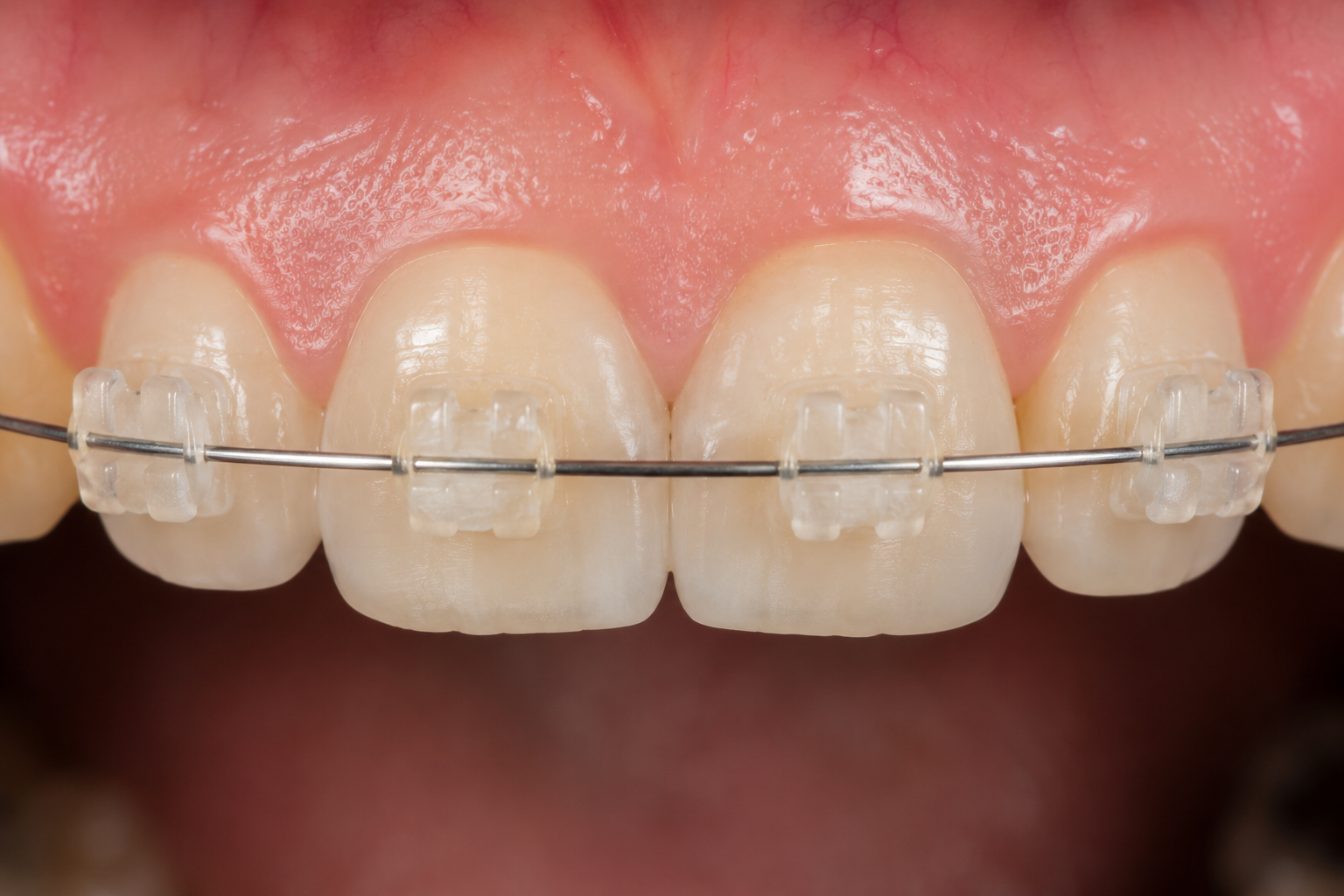 fg ceramic braces karachi